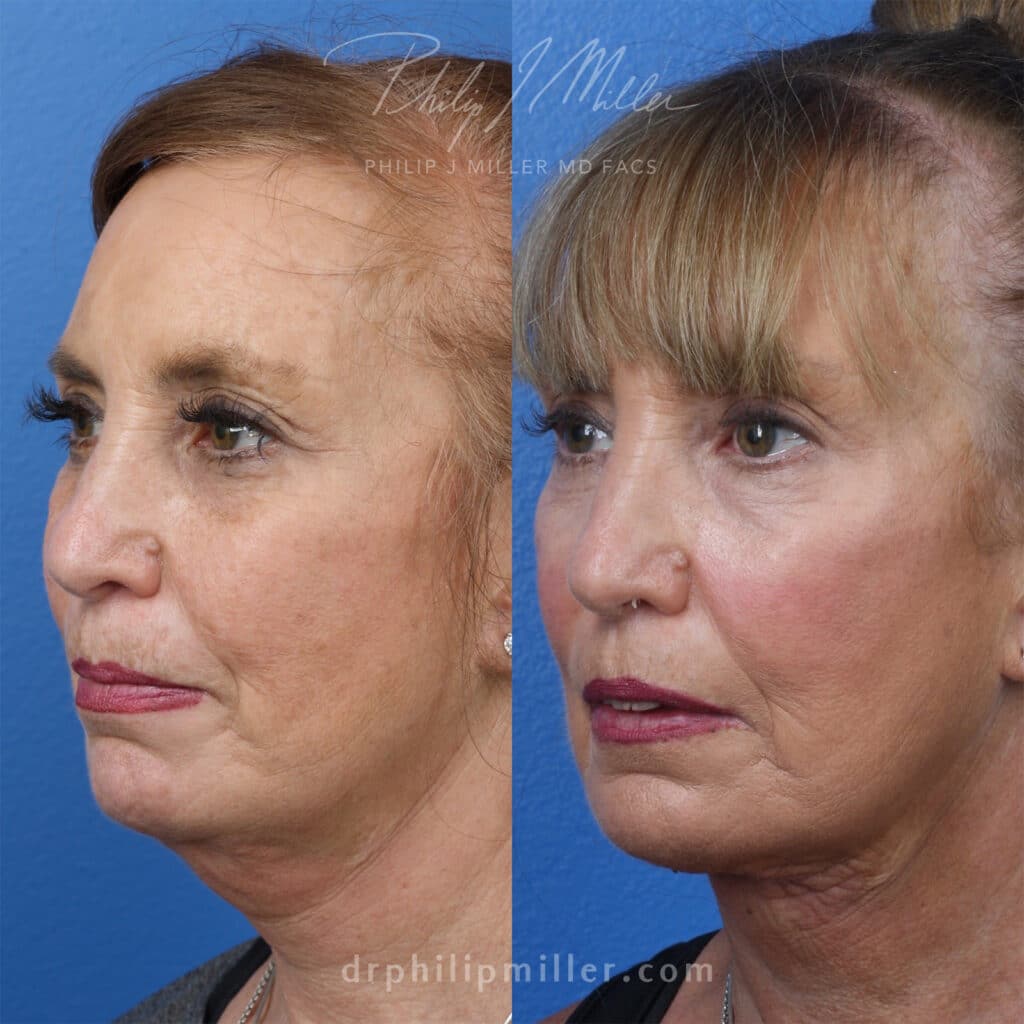 MyEllevate treatment to rejuvenate the lower face, by Dr. Miller. After treatment, skin looks firmer and there is more definition along the jawline.