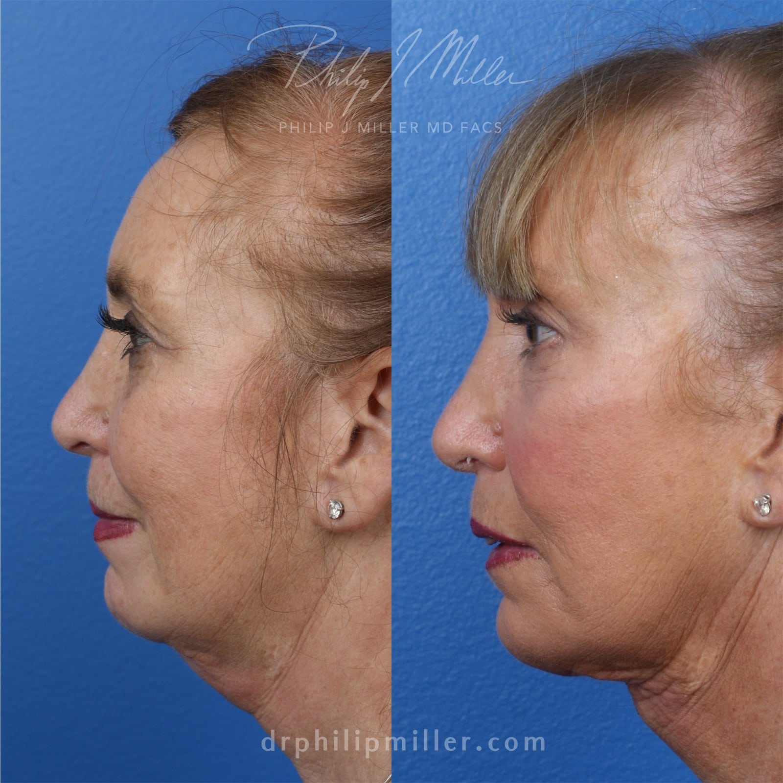MyEllevate treatment to rejuvenate the lower face, by Dr. Miller. After treatment, skin looks firmer and there is more definition along the jawline.