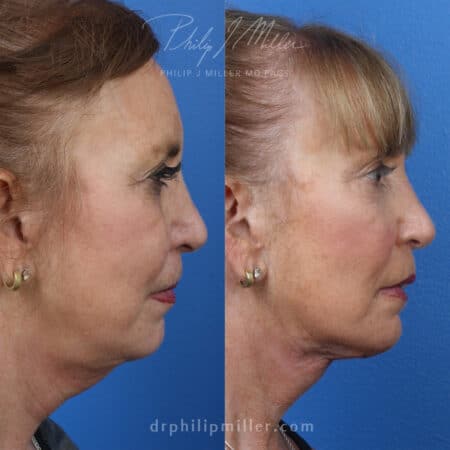 MyEllevate treatment to rejuvenate the lower face, by Dr. Miller