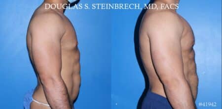 Pectoral implants to enhance the chest by Dr. Steinbrech