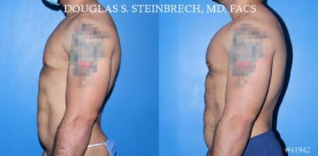 Pectoral implants to enhance the chest by Dr. Steinbrech