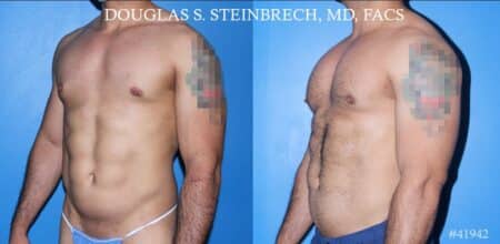 Pectoral implants to enhance the chest by Dr. Steinbrech