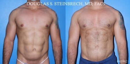 Pectoral implants to enhance the chest by Dr. Steinbrech