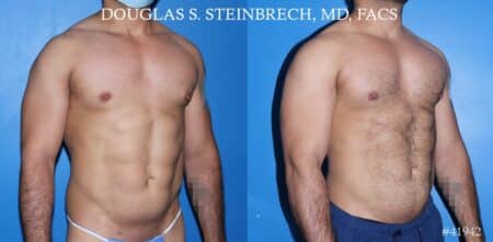 Pectoral implants to enhance the chest by Dr. Steinbrech