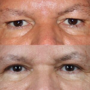 male blepharoplasty surgery results in NYC, NY