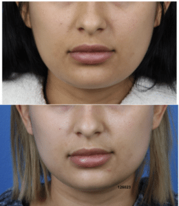 Before and after image of a buccal fat removal procedure performed in New York City