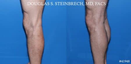 Calf implants to augment the lower leg by Dr. Steinbrech