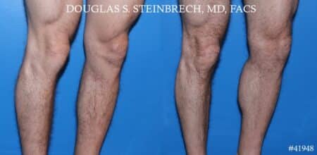 Calf implants to augment the lower leg by Dr. Steinbrech