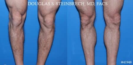 Calf implants to augment the lower leg by Dr. Steinbrech