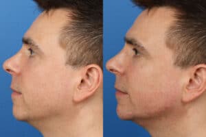 male jawline contouring results in NY, NY