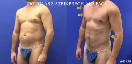 Liposuction with body banking to augment the pecs and shoulders by Dr. Steinbrech