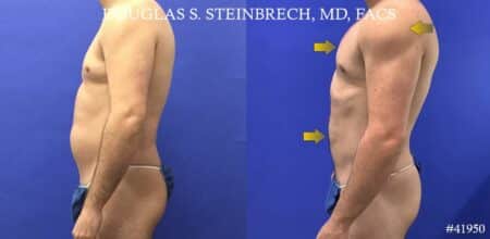 Liposuction with body banking to augment the pecs and shoulders by Dr. Steinbrech