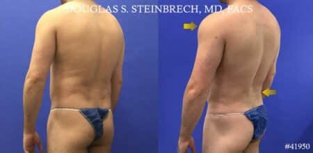 Liposuction with body banking to augment the pecs and shoulders by Dr. Steinbrech