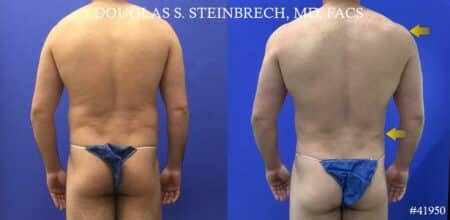 Liposuction with body banking to augment the pecs and shoulders by Dr. Steinbrech