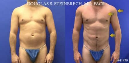 Liposuction with body banking to augment the pecs and shoulders by Dr. Steinbrech