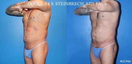 Liposuction with body banking to augment pecs and glutes by Dr. Steinbrech