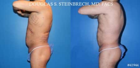 Liposuction with body banking to augment pecs and glutes by Dr. Steinbrech