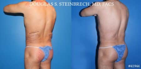 Liposuction with body banking to augment pecs and glutes by Dr. Steinbrech