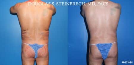 Liposuction with body banking to augment pecs and glutes by Dr. Steinbrech