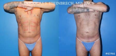 Liposuction with body banking to augment pecs and glutes by Dr. Steinbrech