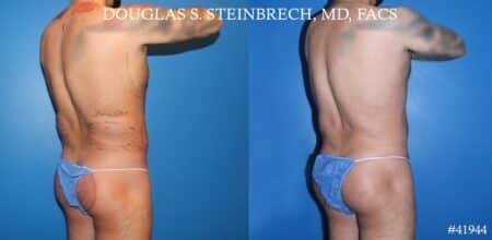 Liposuction with body banking to augment pecs and glutes by Dr. Steinbrech