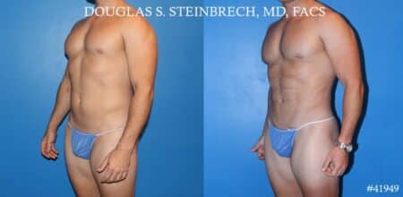 Liposuction and body banking to sculpt midsection, augment pecs and shoulders by Dr. Steinbrech