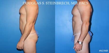 Liposuction and body banking to sculpt midsection, augment pecs and shoulders by Dr. Steinbrech