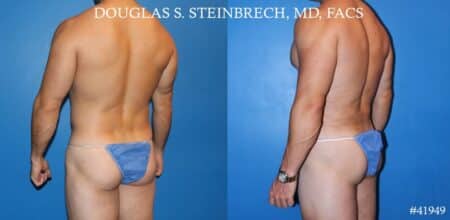 Liposuction and body banking to sculpt midsection, augment pecs and shoulders by Dr. Steinbrech