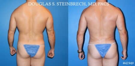 Liposuction and body banking to sculpt midsection, augment pecs and shoulders by Dr. Steinbrech