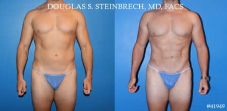 Liposuction and body banking to sculpt midsection, augment pecs and shoulders by Dr. Steinbrech