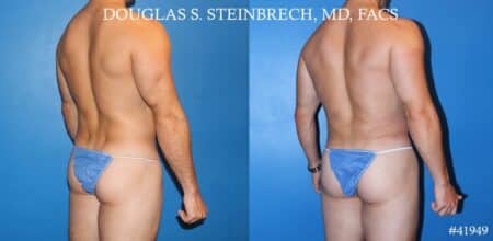 Liposuction and body banking to sculpt midsection, augment pecs and shoulders by Dr. Steinbrech