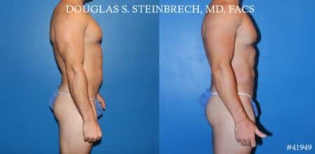 Liposuction and body banking to sculpt midsection, augment pecs and shoulders by Dr. Steinbrech