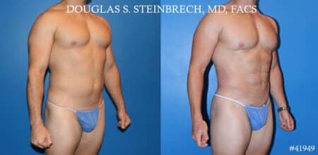 Liposuction and body banking to sculpt midsection, augment pecs and shoulders by Dr. Steinbrech