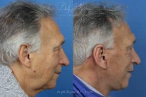 Neck lift to rejuvenate the neck and jawline by Dr. Miller. Surgery removes loose skin and creates more defined definition between jawline and neck.