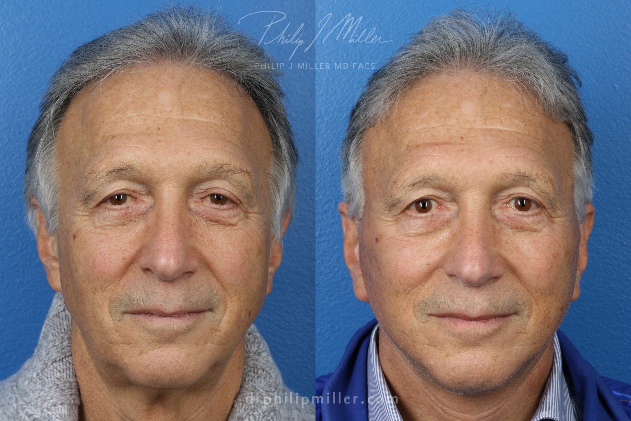 Neck lift to rejuvenate the neck and jawline by Dr. Miller. Surgery removes loose skin and creates more defined definition between jawline and neck.