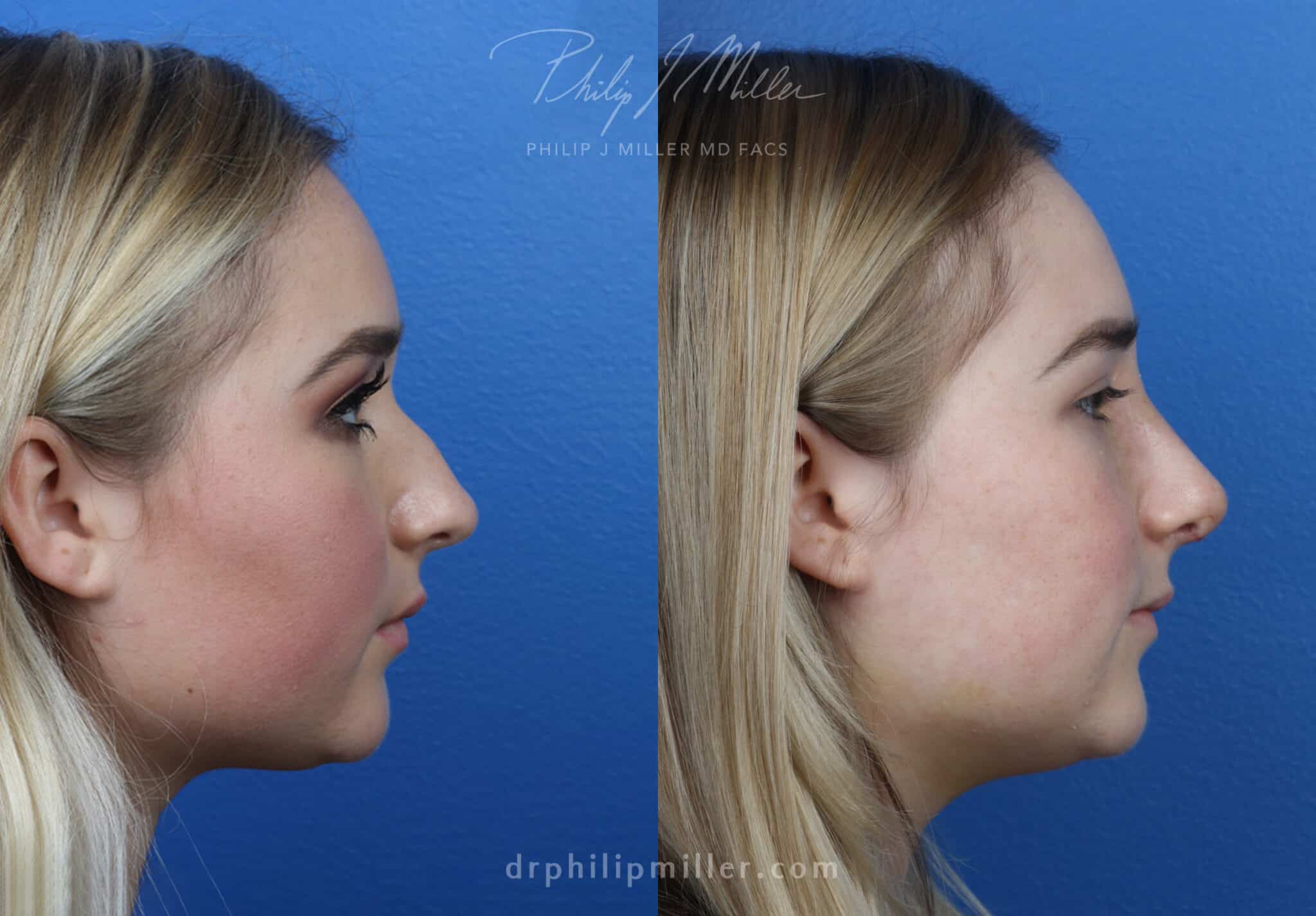 Rhinoplasty to adjust the nasal bridge by Dr. Miller. After surgery, nasal bridge is straighter and tip slightly rotated for an improved profile.
