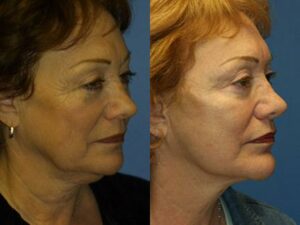 SMAS facelift surgery results in New York City