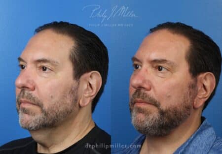 Facelift and neck lift to rejuvenate the appearance of a male patient by Dr. Miller