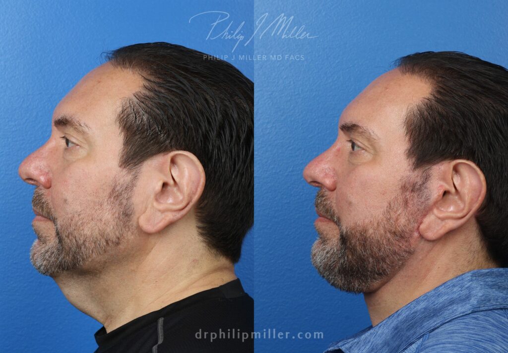 Facelift and neck lift to rejuvenate the appearance of a male patient by Dr. Miller. After surgery, loose neck skin is gone and jaw is more defined.