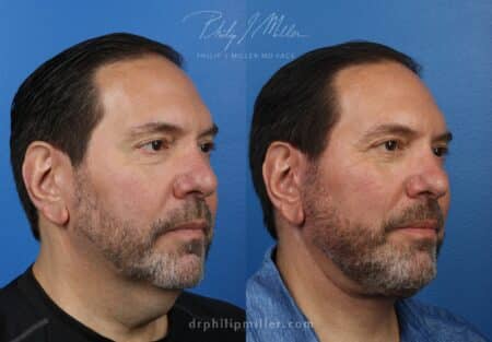 Facelift and neck lift to rejuvenate the appearance of a male patient by Dr. Miller