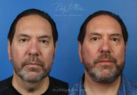 Facelift and neck lift to rejuvenate the appearance of a male patient by Dr. Miller