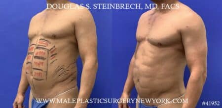 Liposuction with body banking to augment the abs by Dr. Steinbrech