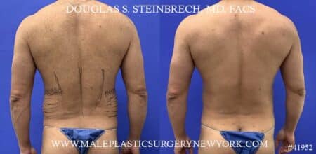 Liposuction with body banking to augment the abs by Dr. Steinbrech