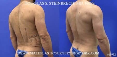 Liposuction with body banking to augment the abs by Dr. Steinbrech.