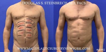 Liposuction with body banking to augment the abs by Dr. Steinbrech