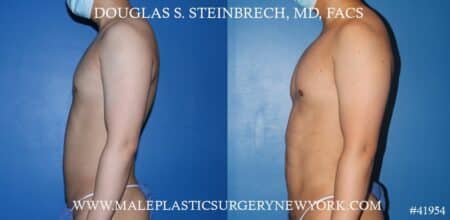 Liposuction with body banking to augment the pecs and shoulders by Dr. Steinbrech