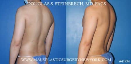 Liposuction with body banking to augment the pecs and shoulders by Dr. Steinbrech