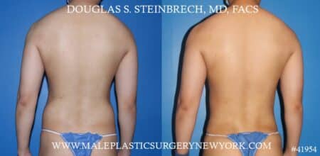 Liposuction with body banking to augment the pecs and shoulders by Dr. Steinbrech