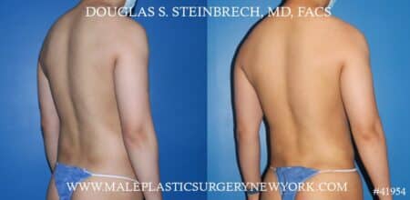 Liposuction with body banking to augment the pecs and shoulders by Dr. Steinbrech