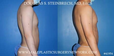 Liposuction with body banking to augment the pecs and shoulders by Dr. Steinbrech